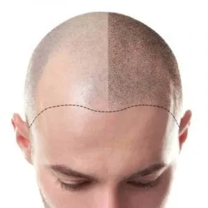 scalp care scalp micropigmentation SMP Strathfield