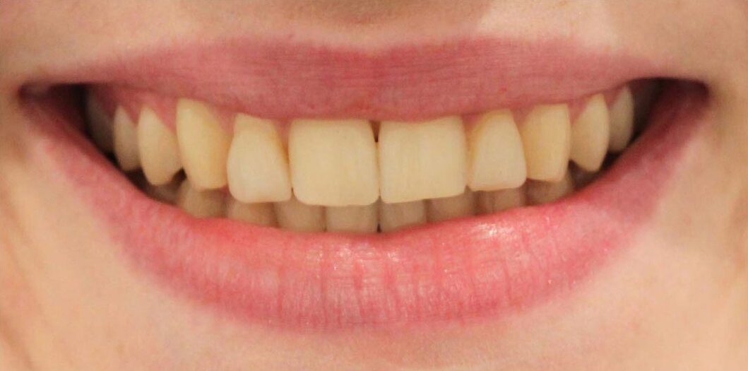 smiling-dental-teeth-whitening-before-after-1 (1)