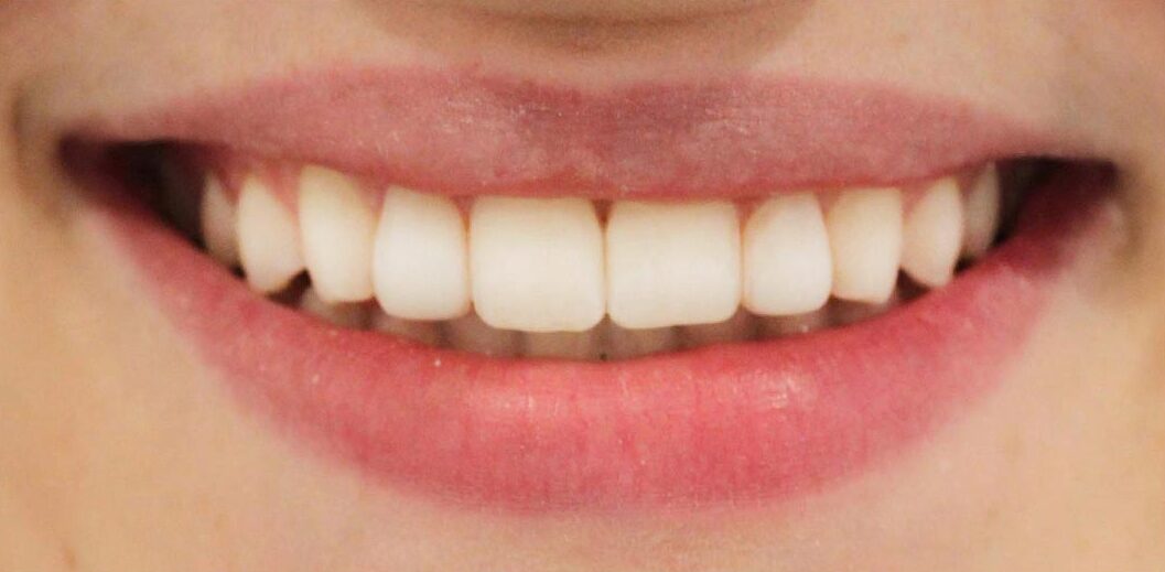 smiling-dental-teeth-whitening-before-after-1 (2)
